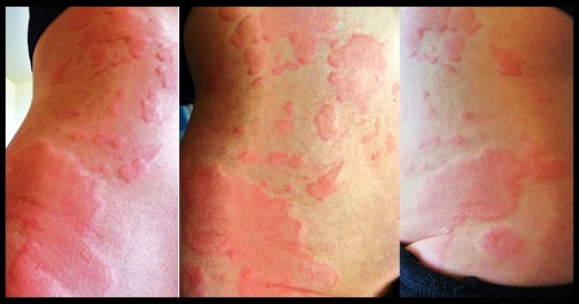 hives after drinking alcohol