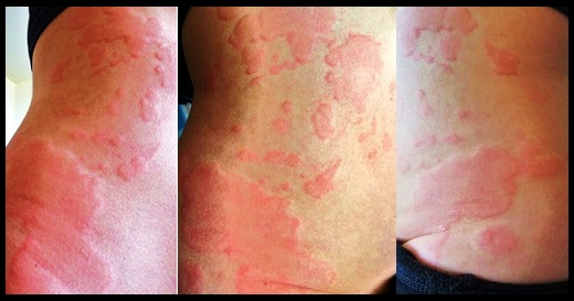 Autoimmune Urticaria Treatment And Diet