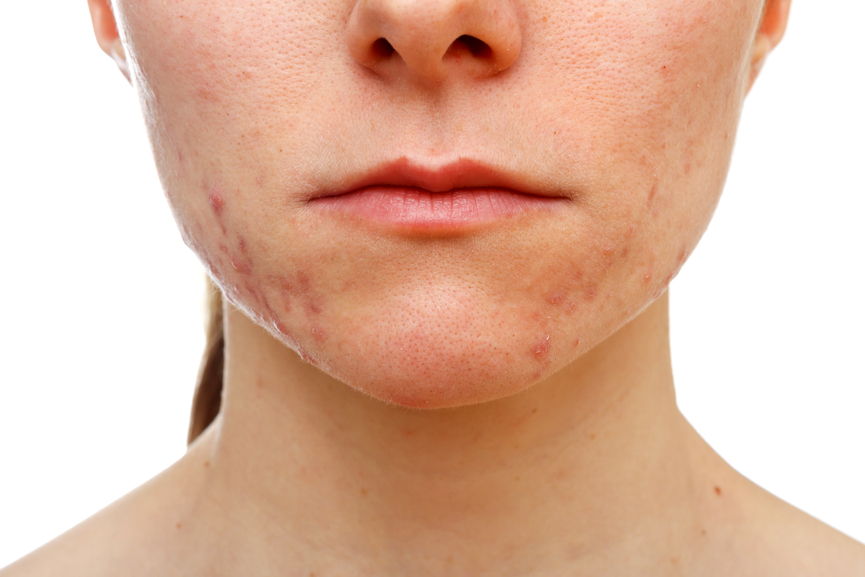 Adult Acne - Treatment Options & Support - Acne.org